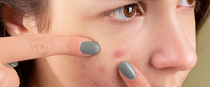 Conheça os tipos de manchas na pele e tratamentos indicados | Bioage