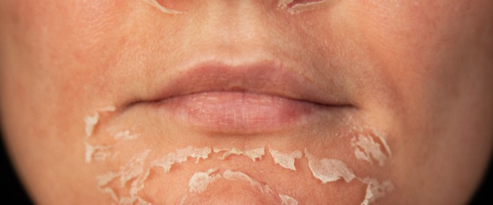 Pré e pós-peeling: dicas para um tratamento completo | Bioage